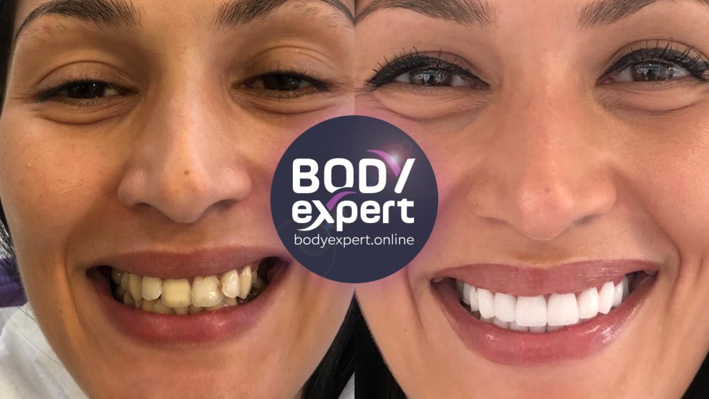 06-Inès-Avant-Apres-Couronnes-dentaires