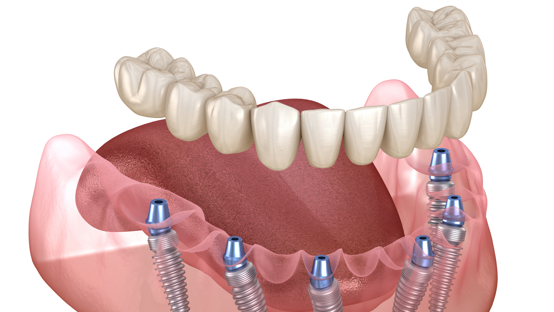 a 3D model of a all-on-6