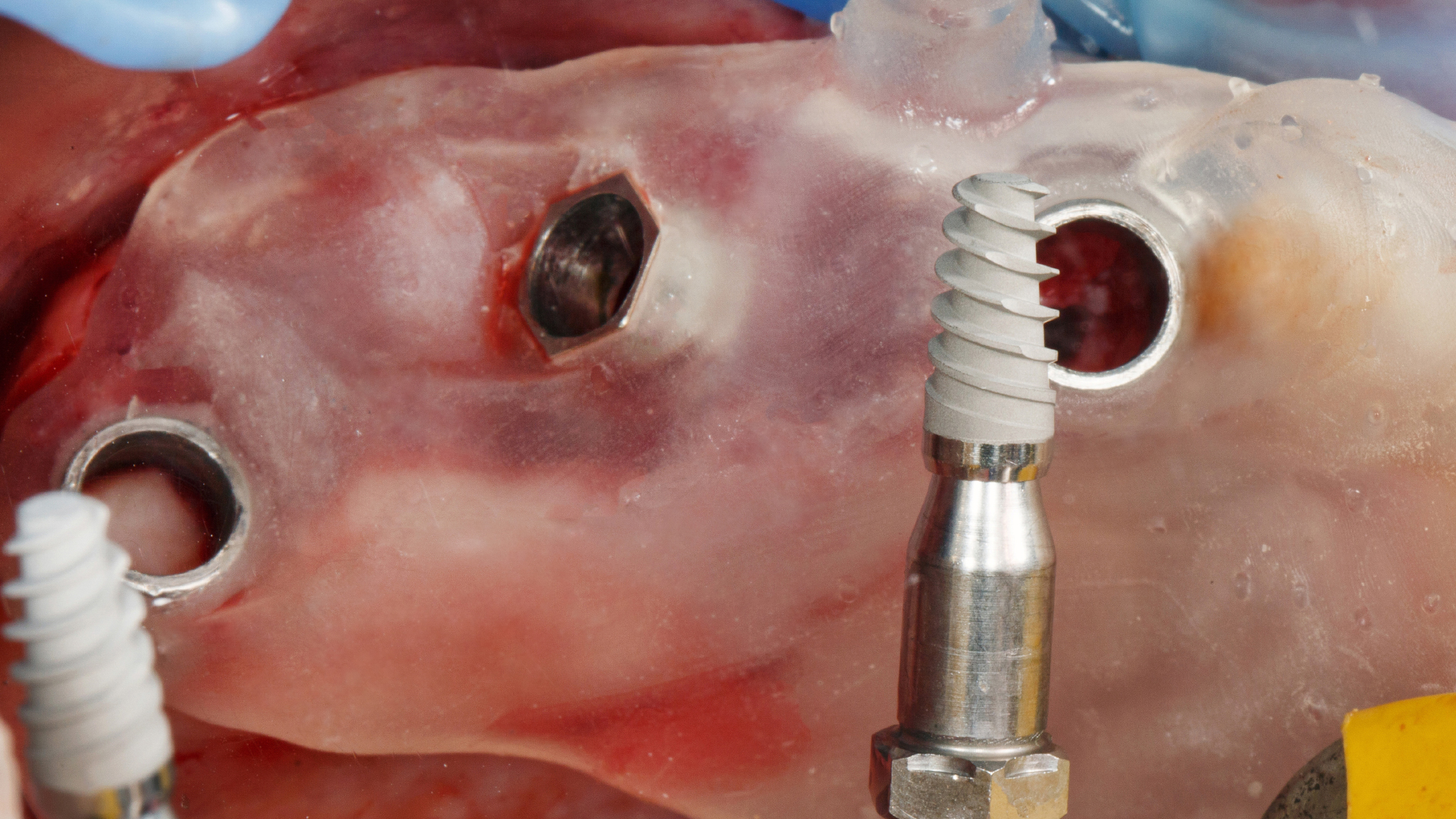 photo de la bouche d’un patient entrain de se faire implanter des implant dentaires, ici des implants courts