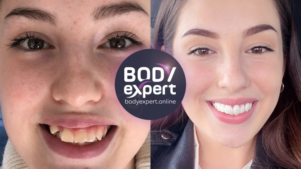 Dental crowns before and after : see our patients' results | Body Expert