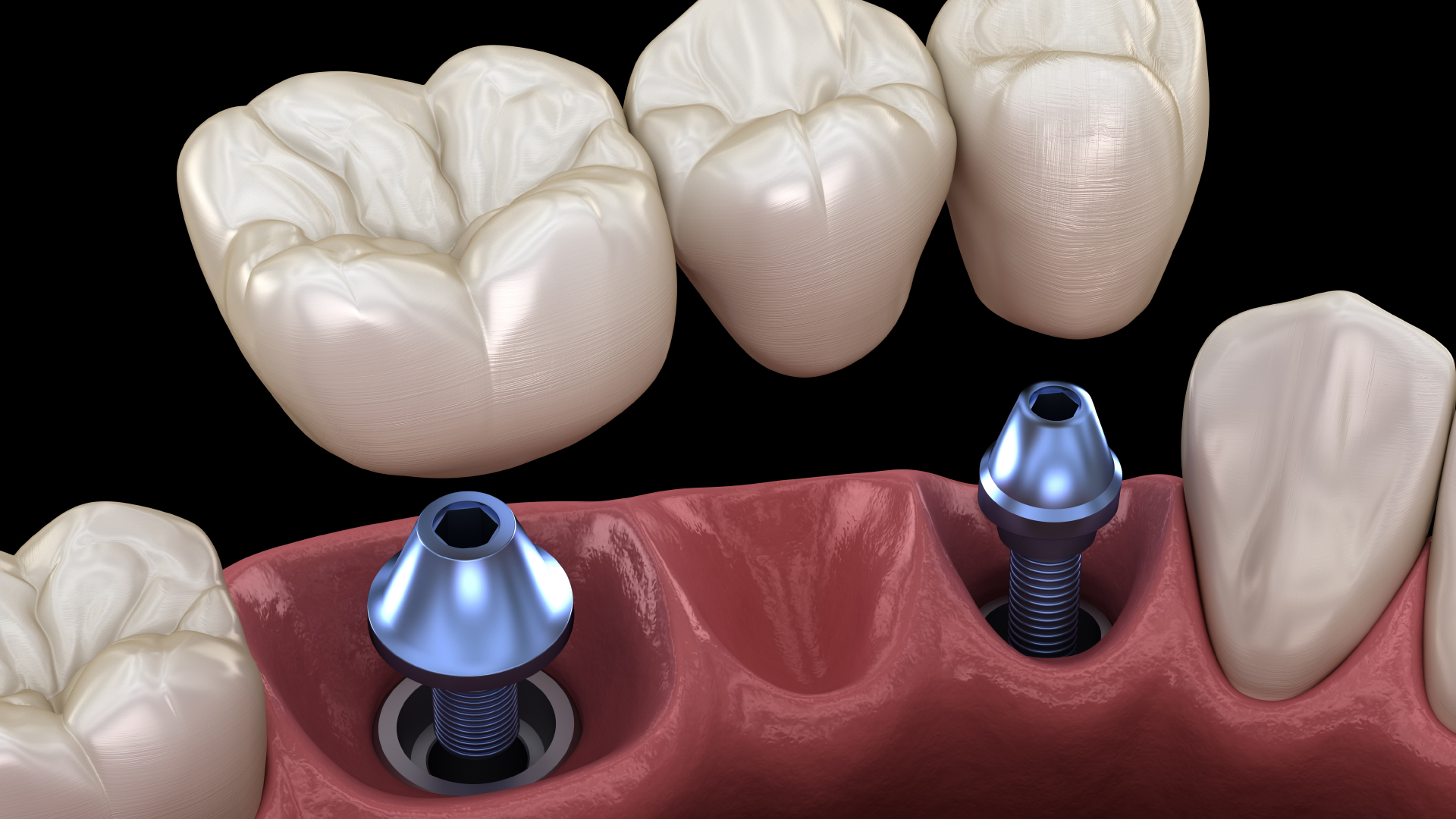 vue en 3D d’un bridge simple sur implant