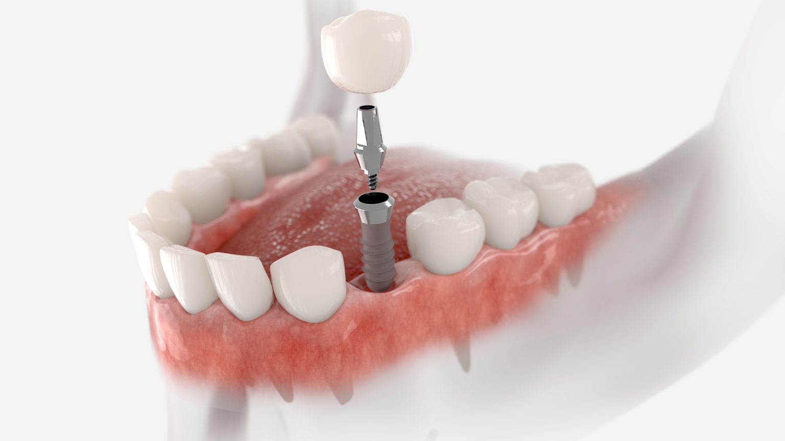 Modèle Implant Dentaire US Pour Prothèses - Mâchoire Supérieure/inférieure Avec 4/6 Vis - Neuf