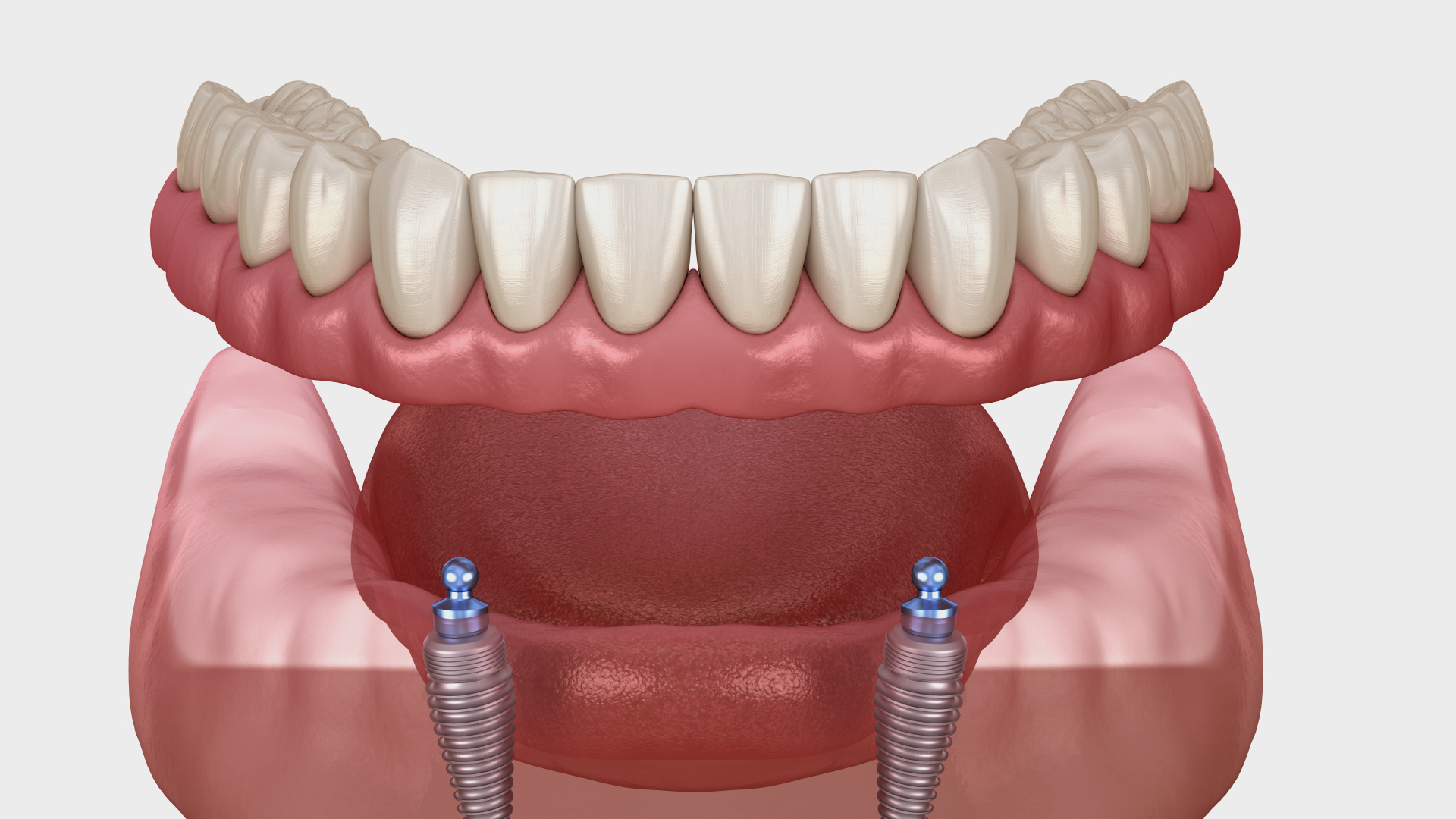 vue 3D d’une prothèse stabilisée sur implant