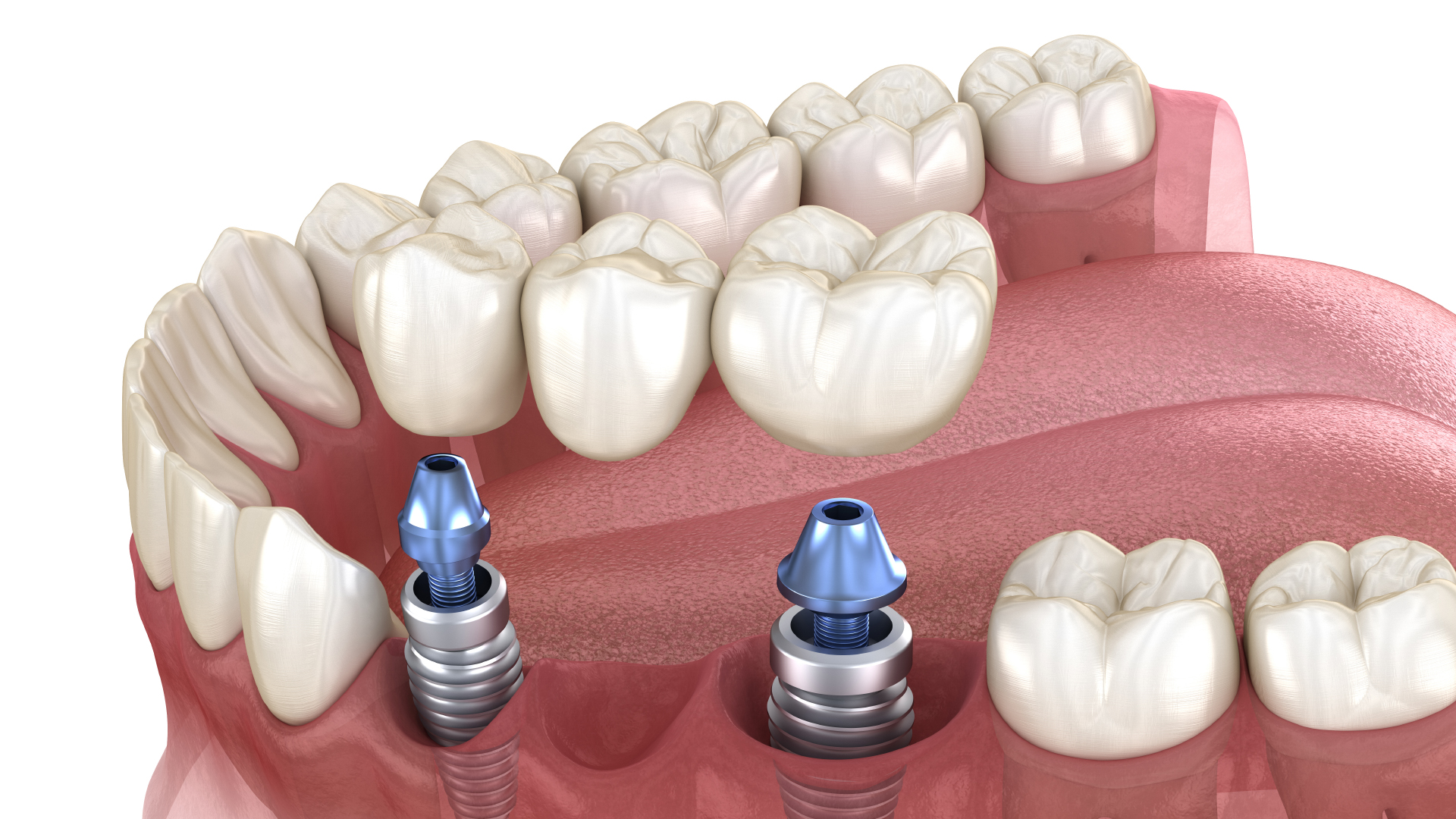 Dents artificielles pour prothèses et appareils dentaires