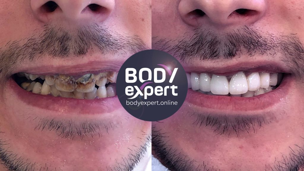 Couronnes dentaire Avant Après, résultats après la pose Body Expert