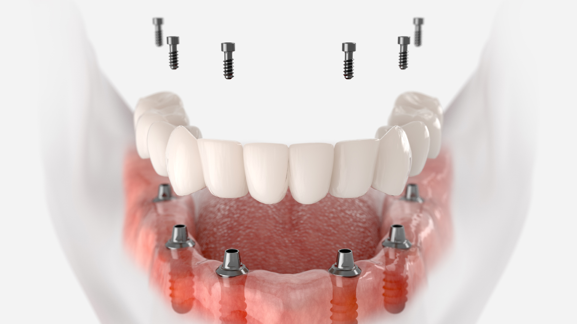 Vue 3D d’une prothèse transvissée sur implant