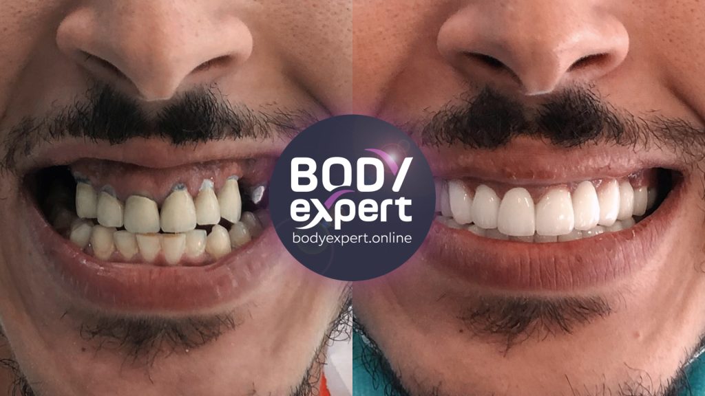 13-Sophien-Avant-Apres-implants-dentaires