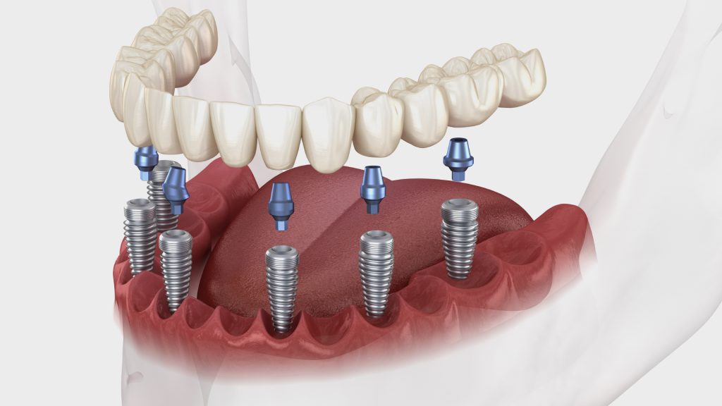 Implants dentaires prix, types, marques, pose et remboursement
