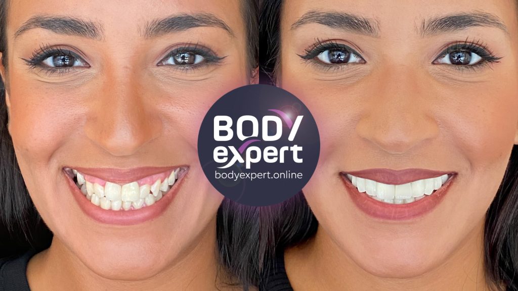 14-Louisa-Avant-Apres-implants-dentaires