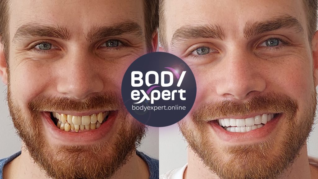 14-Quentin-Avant-Apres-Couronnes-dentaires