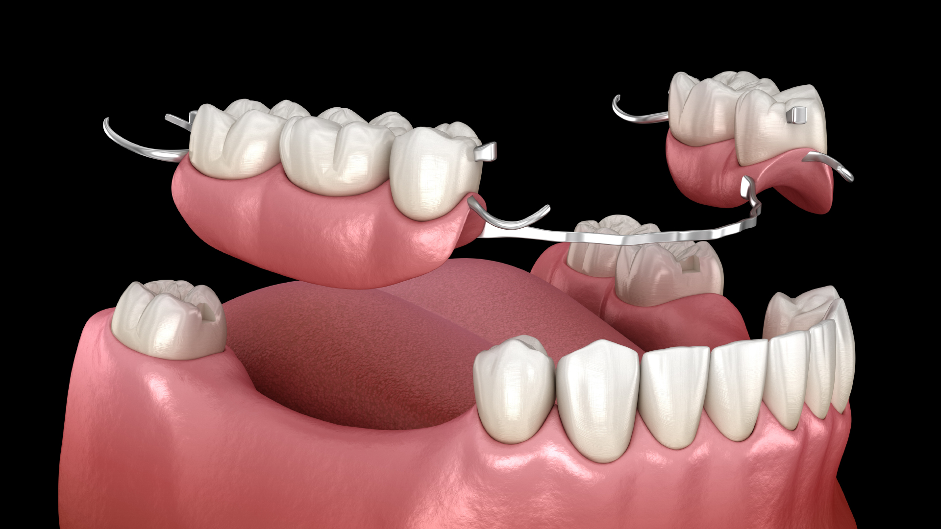 Dents artificielles pour dentier, appareil dentaire et stellite