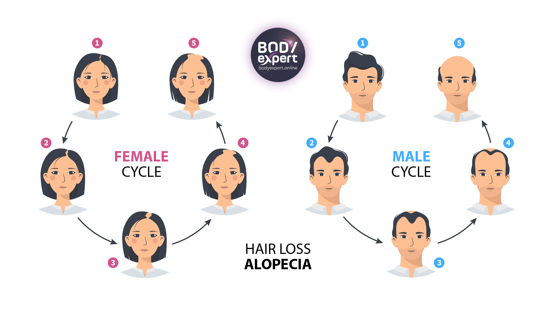 the stage of androgenetic alopecia for men and women