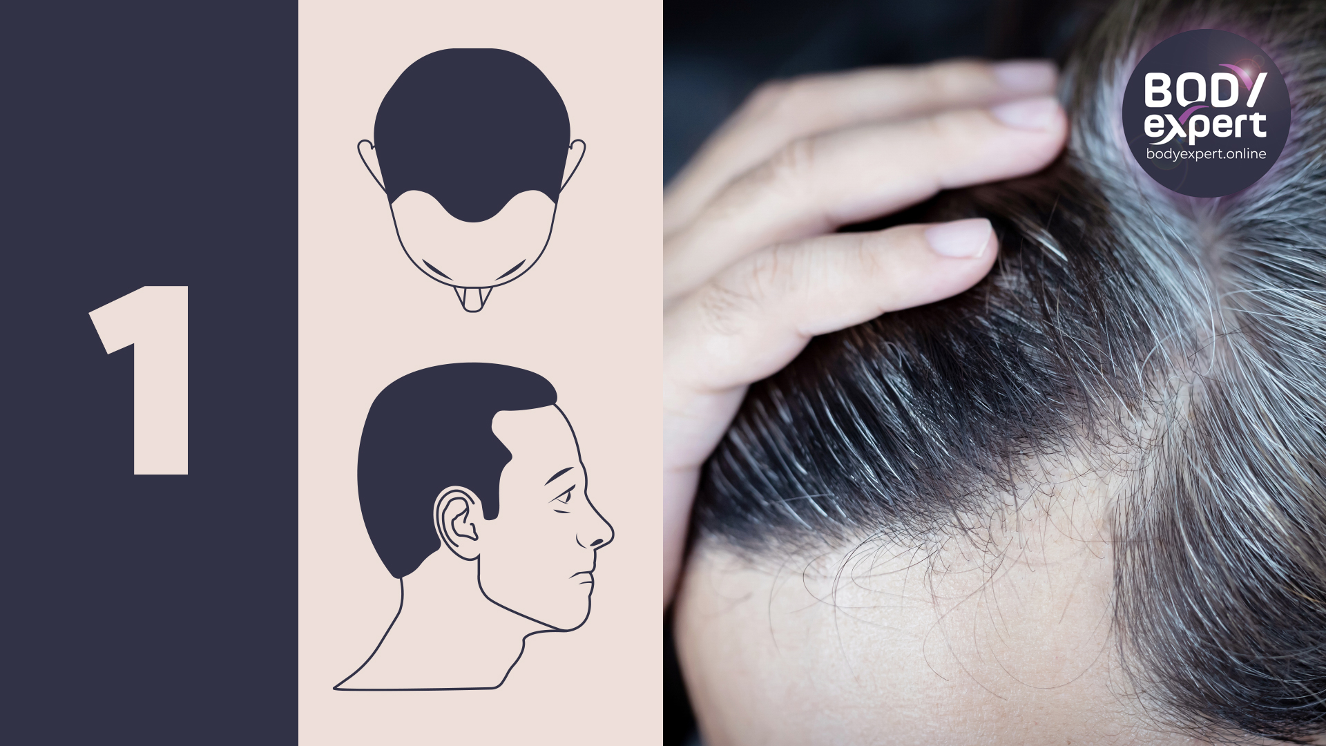 Tassa Ideale Vulcanico Hair Loss Scale Fantoccio Frequentemente Immersione