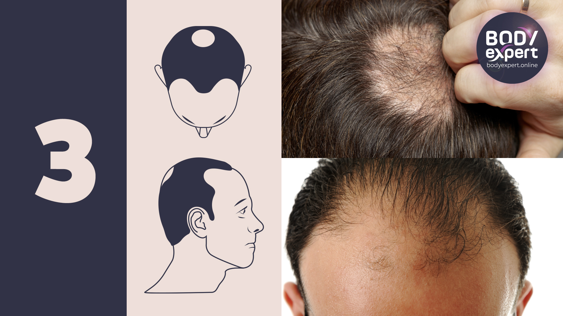 Norwood Hamilton Scale The 7 Stages Of Male Pattern Baldness