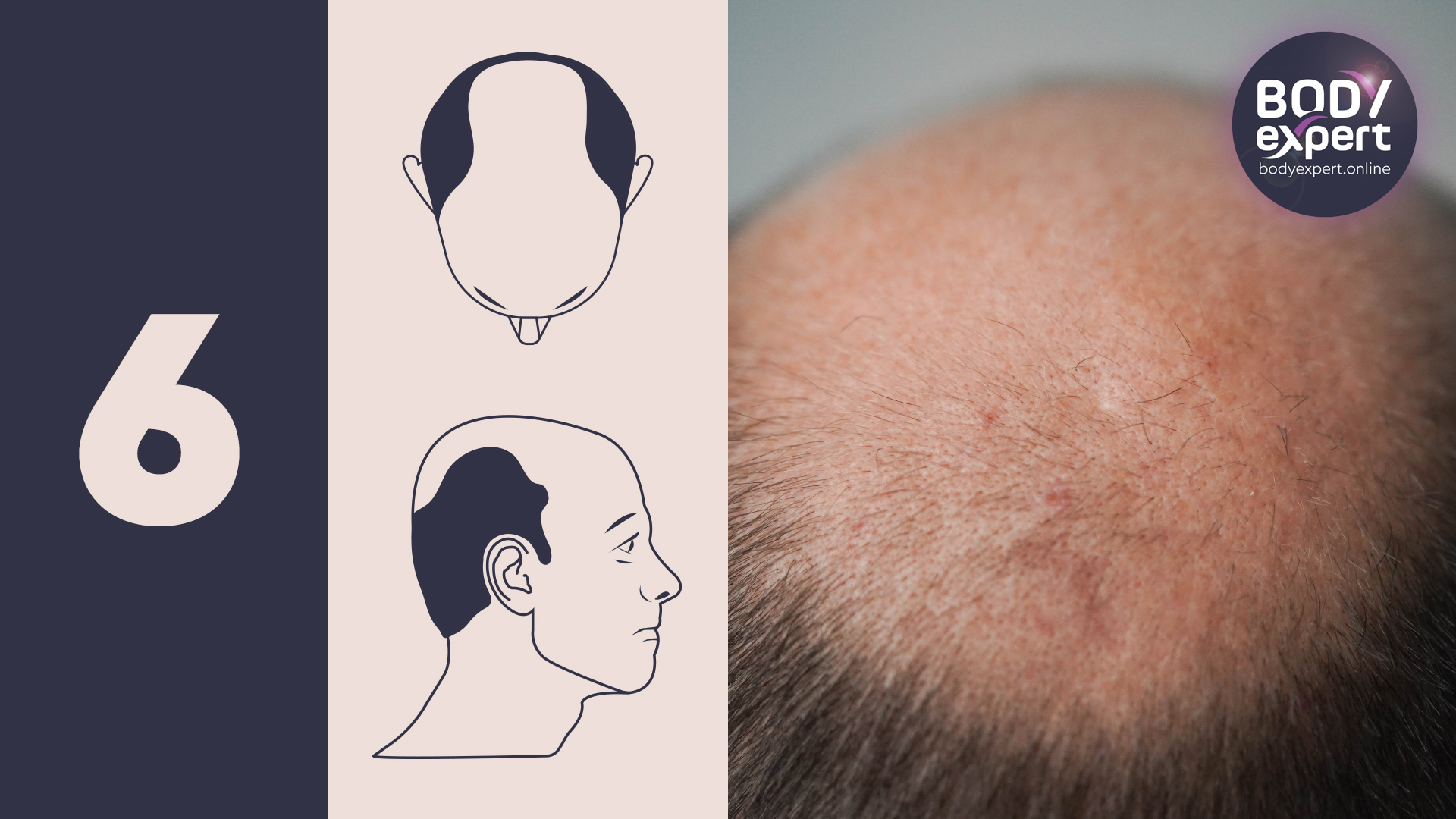 Ludwig scale  Types of hair loss – Neofollics