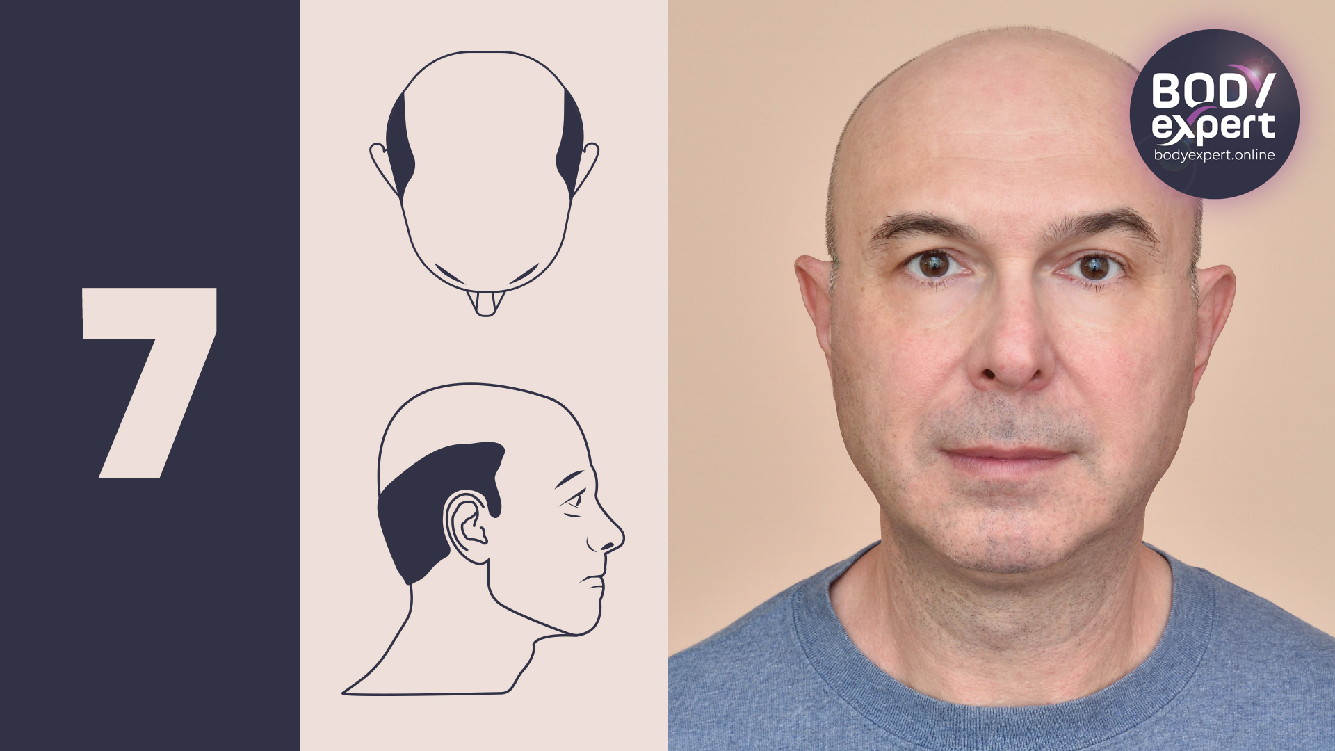 Norwood Stage 7: The most advanced androgenetic alopecia