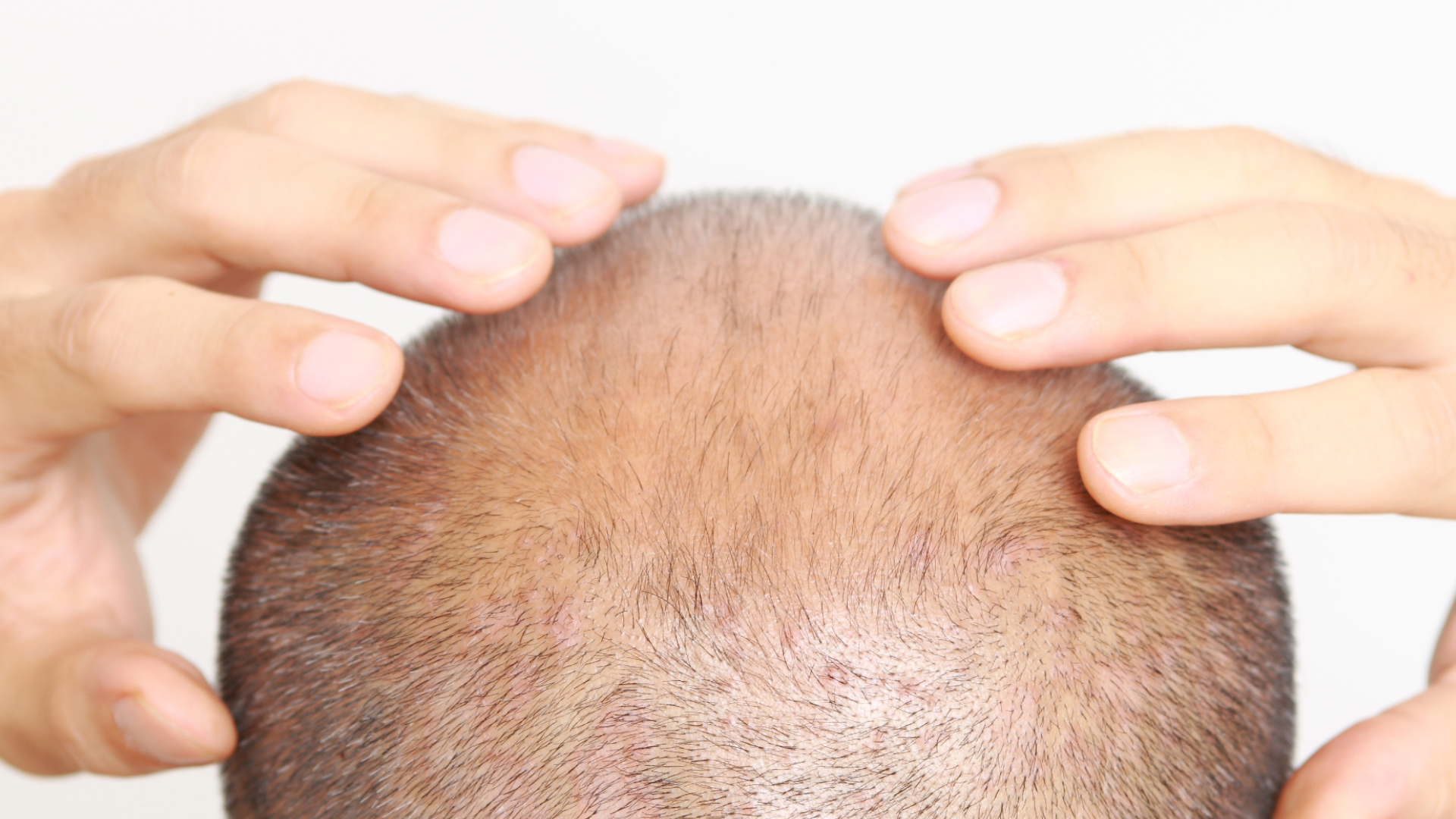a person having Androgenetic Alopecia