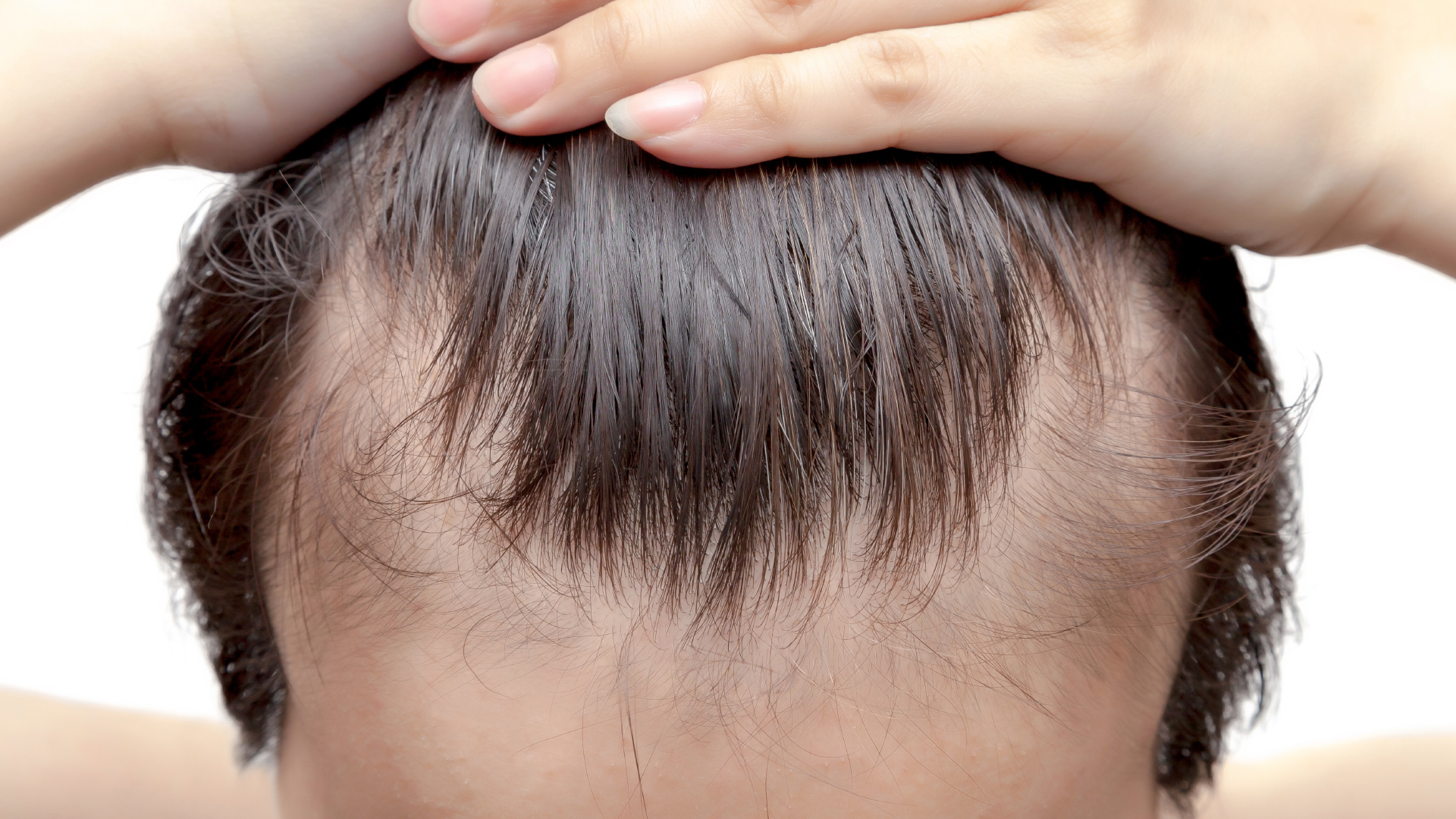 a men at an early stage of hair loss