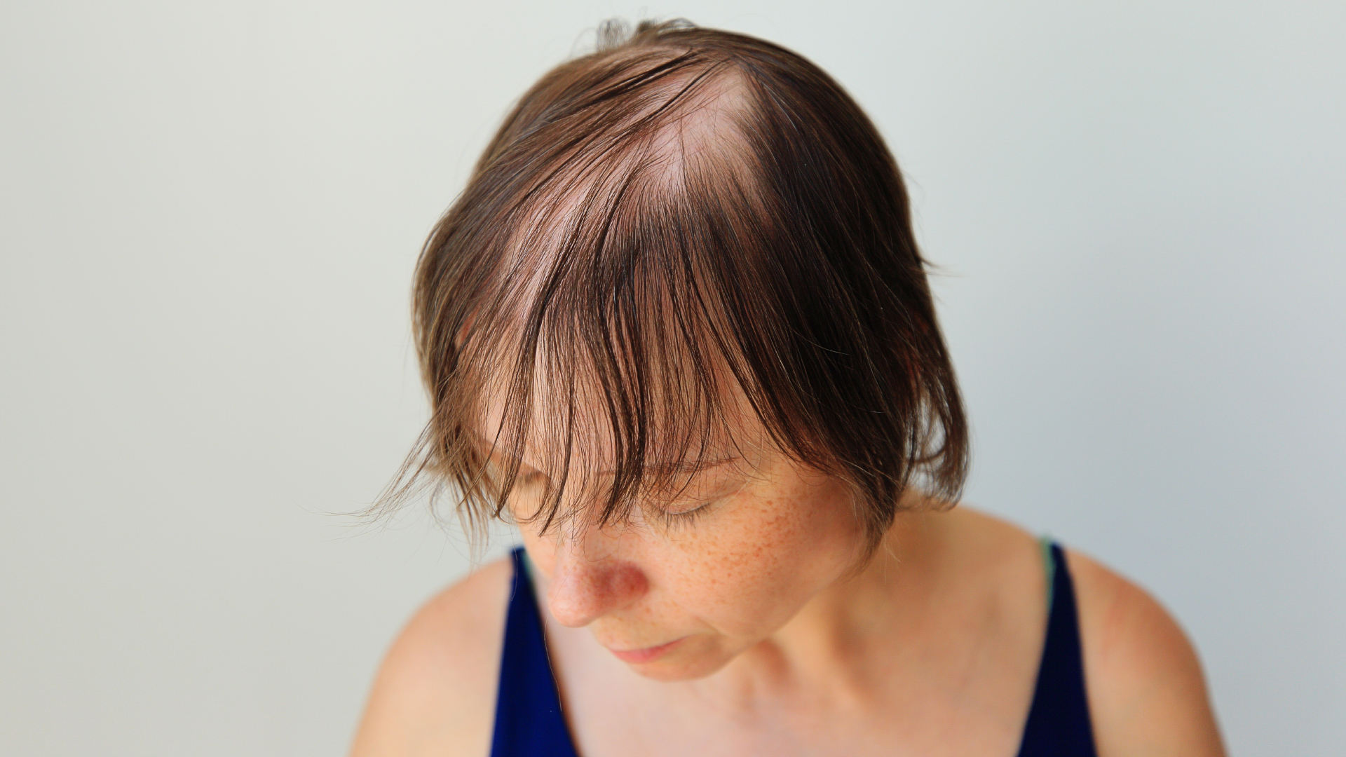 a woman with Androgenetic Alopecia