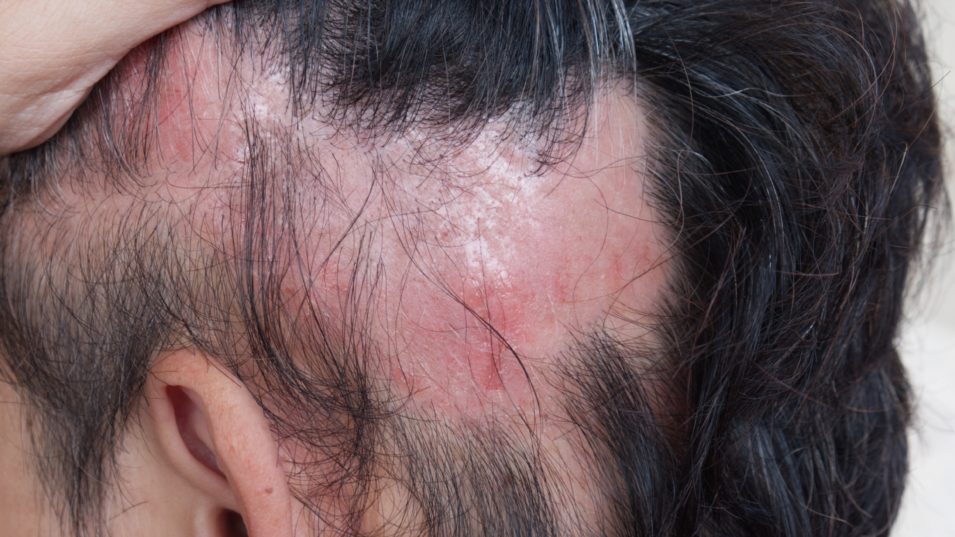 Alopecia stress shop