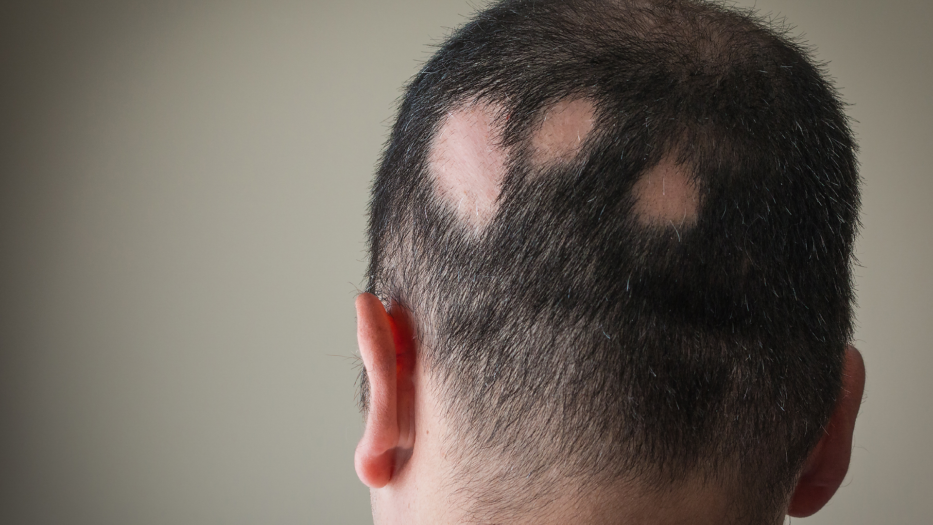 Patchy hair loss