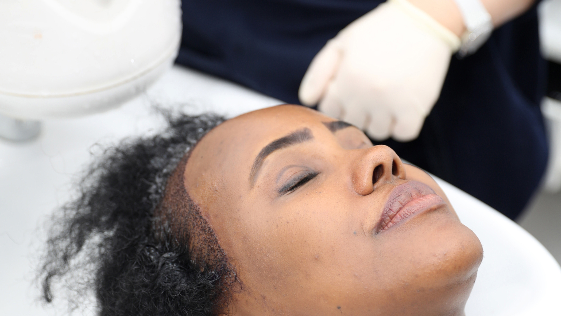 Hair transplant give good results for patient with traction alopecia