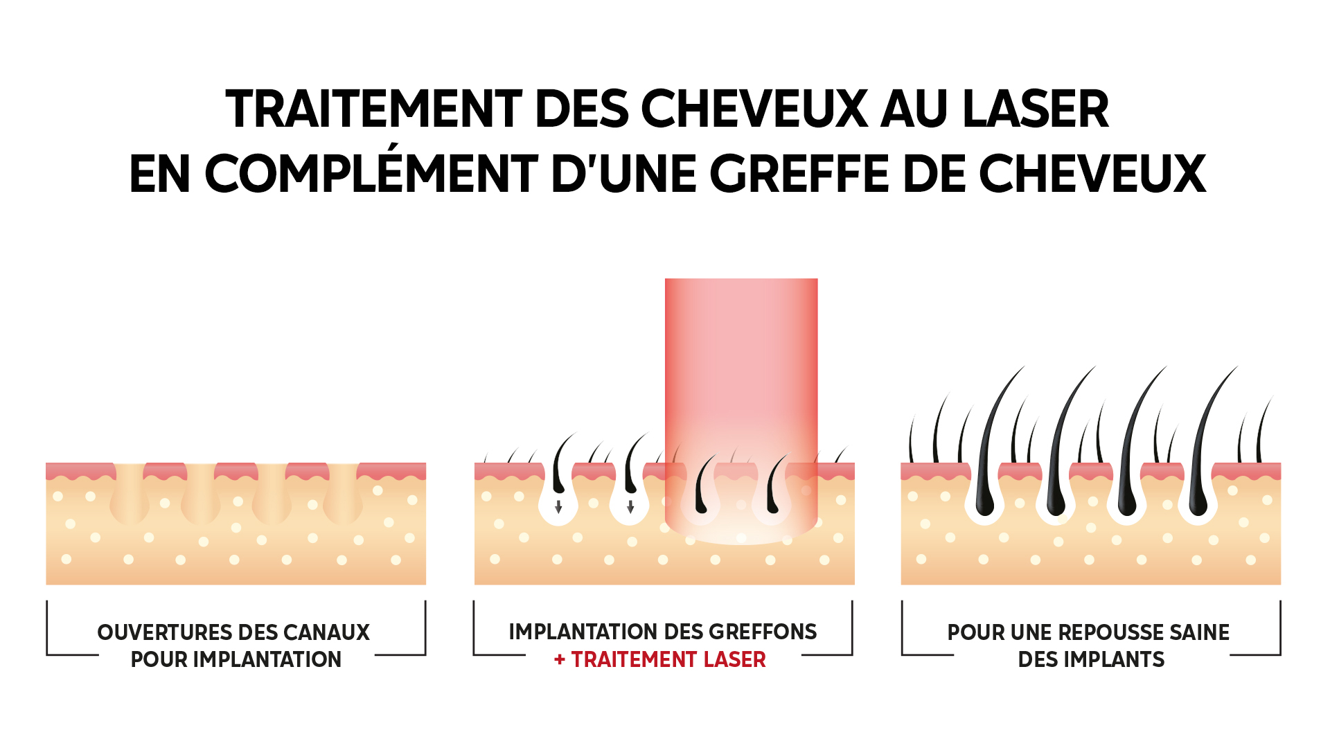 le traitement des cheveux au laser dans le cadre d'une transplantation capillaire