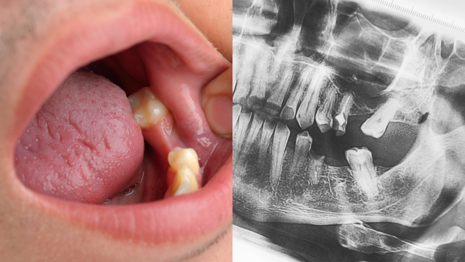 Un patient avec une dent manquante nécessitant la pose d'un implant dentaire