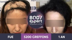 FR-AP-Greffe-de-Cheveux-20