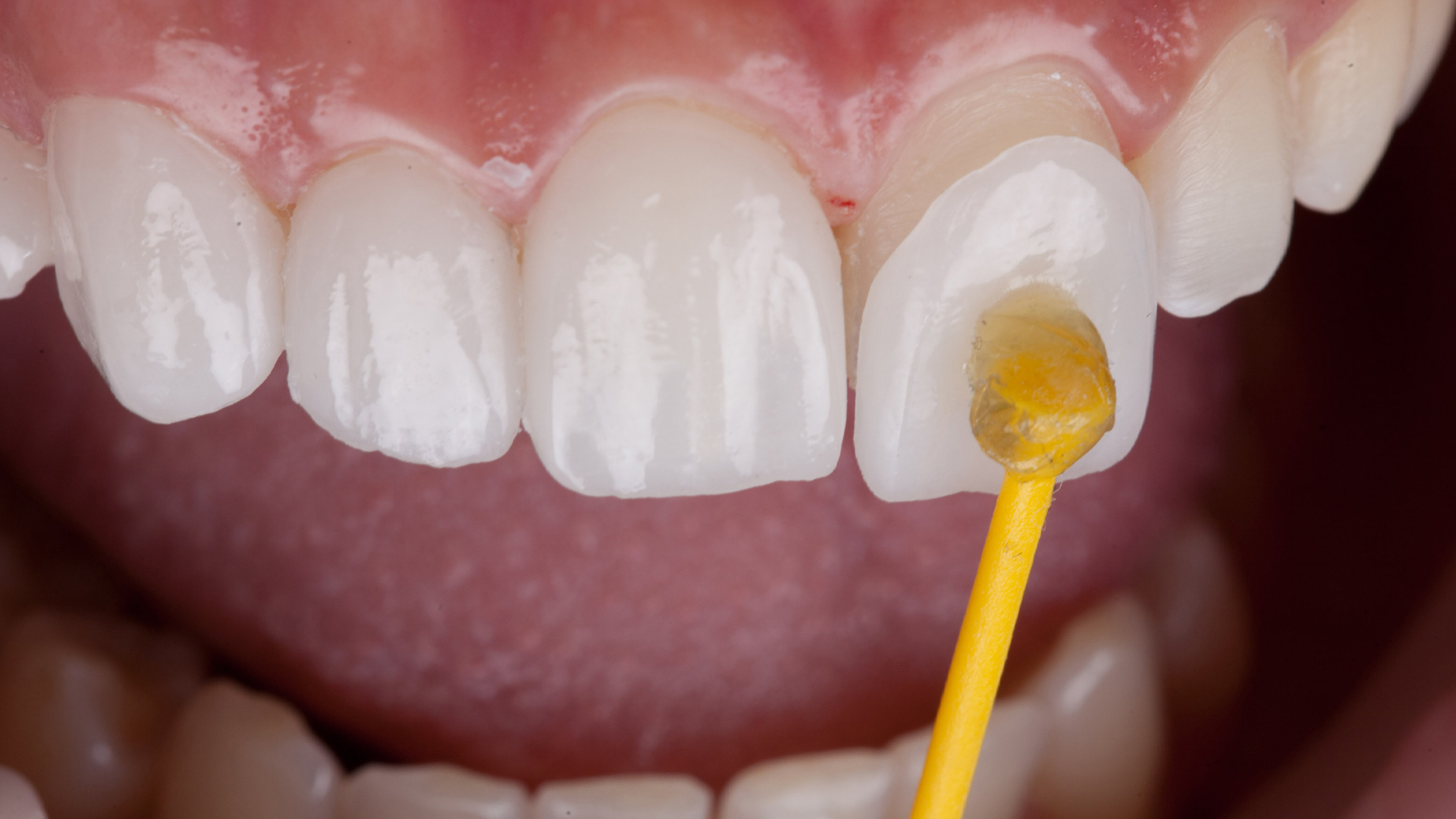 Quels sont les avantages d'opter pour des facettes dentaires ?