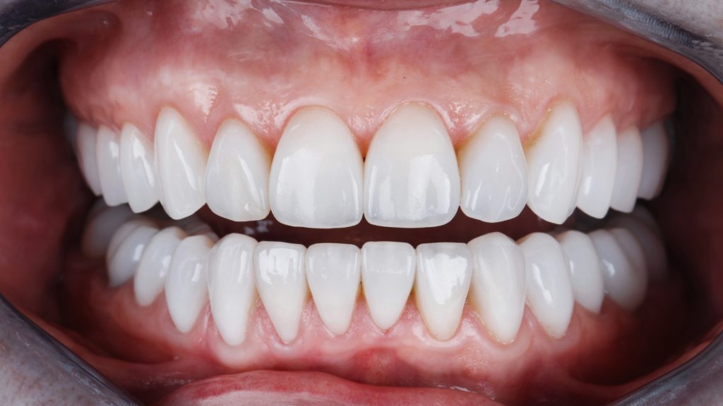 Soldes Dentier Dents - Nos bonnes affaires de janvier