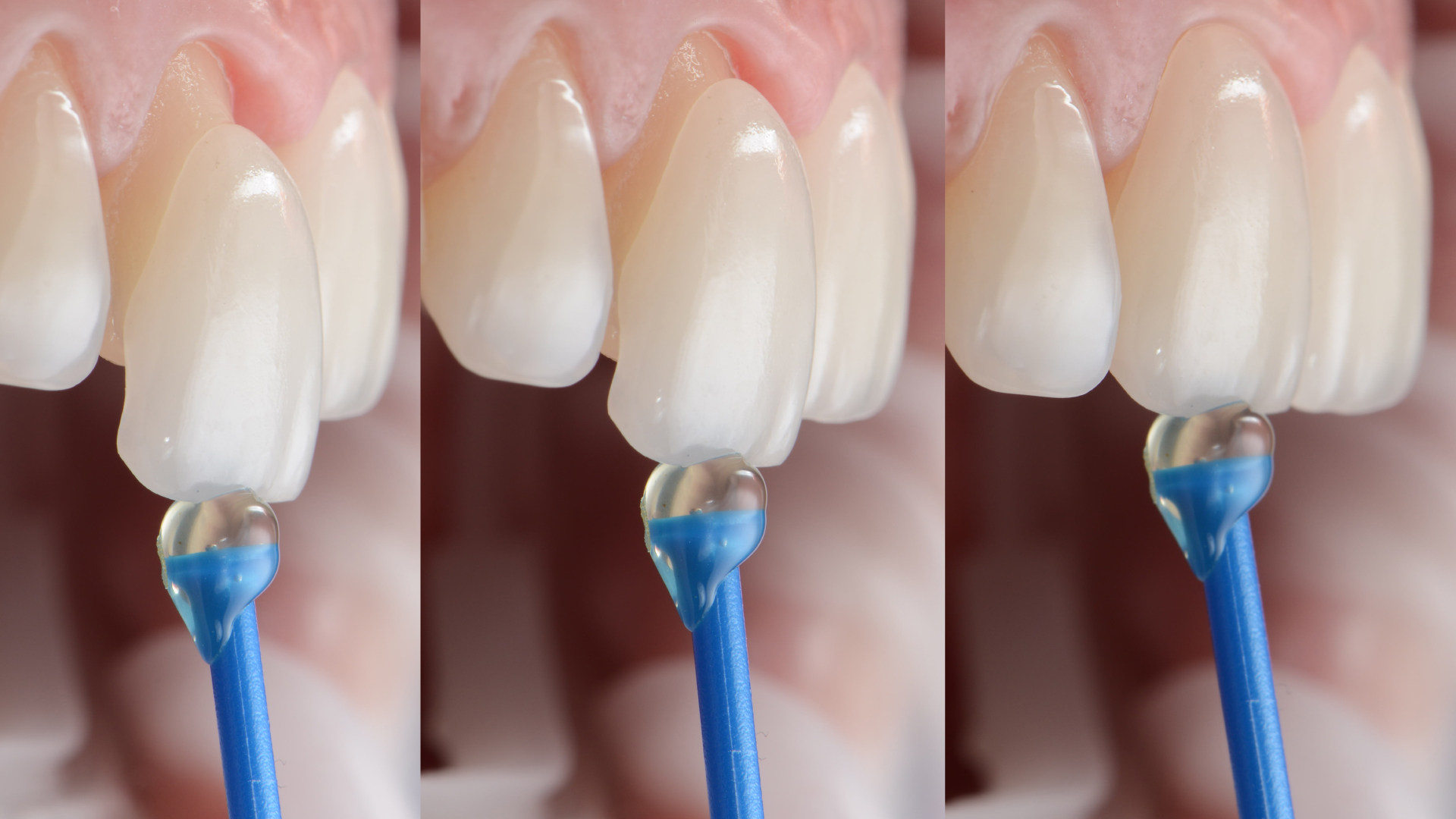 A close up picture a dental veneer placement