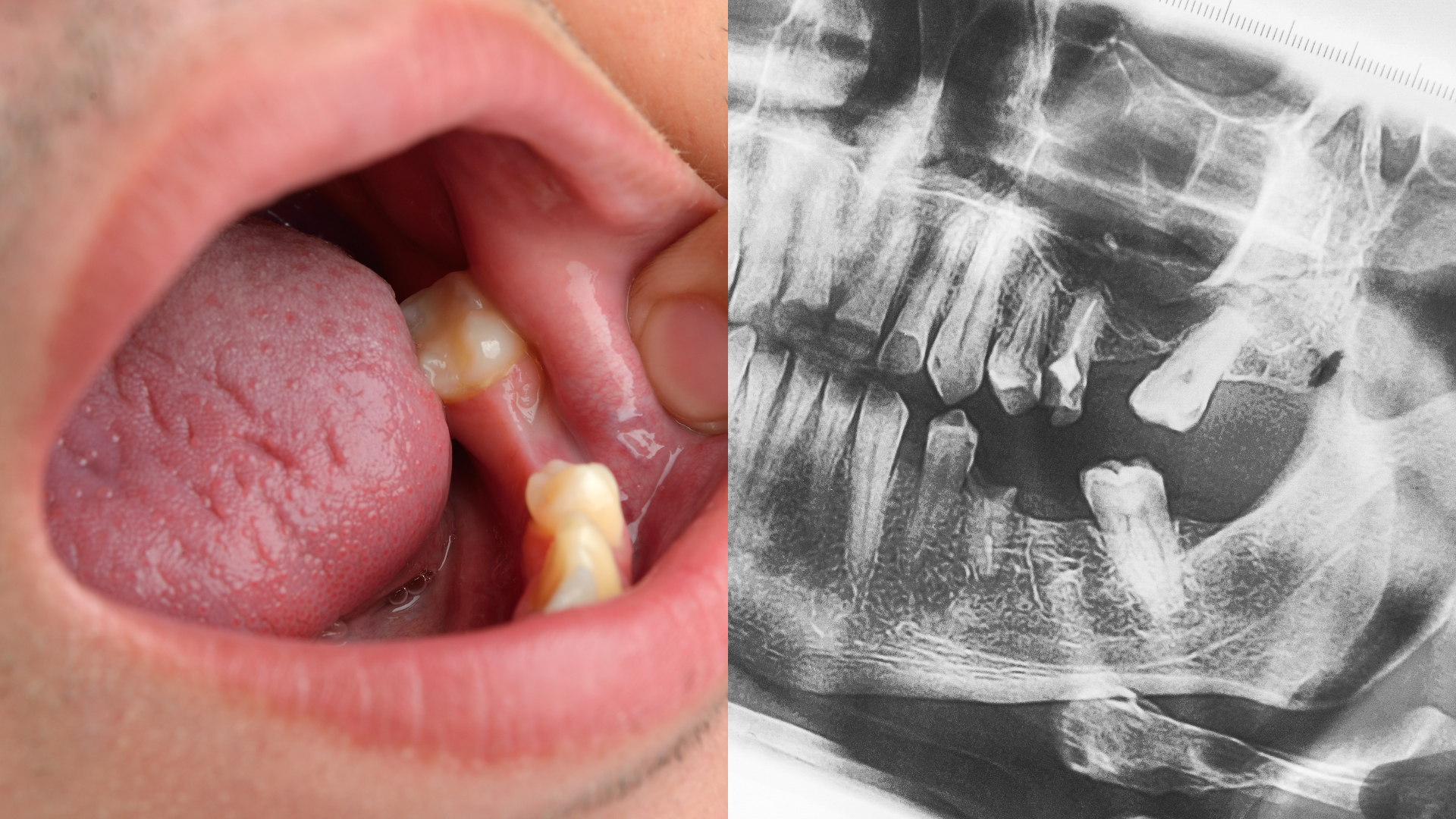 Un patient qui a besoin d'un implant dentaire