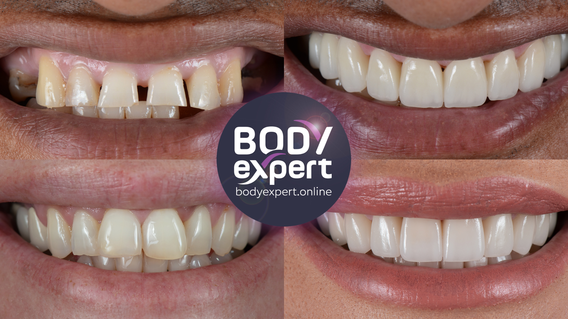 Veneers in Antalya : before - after