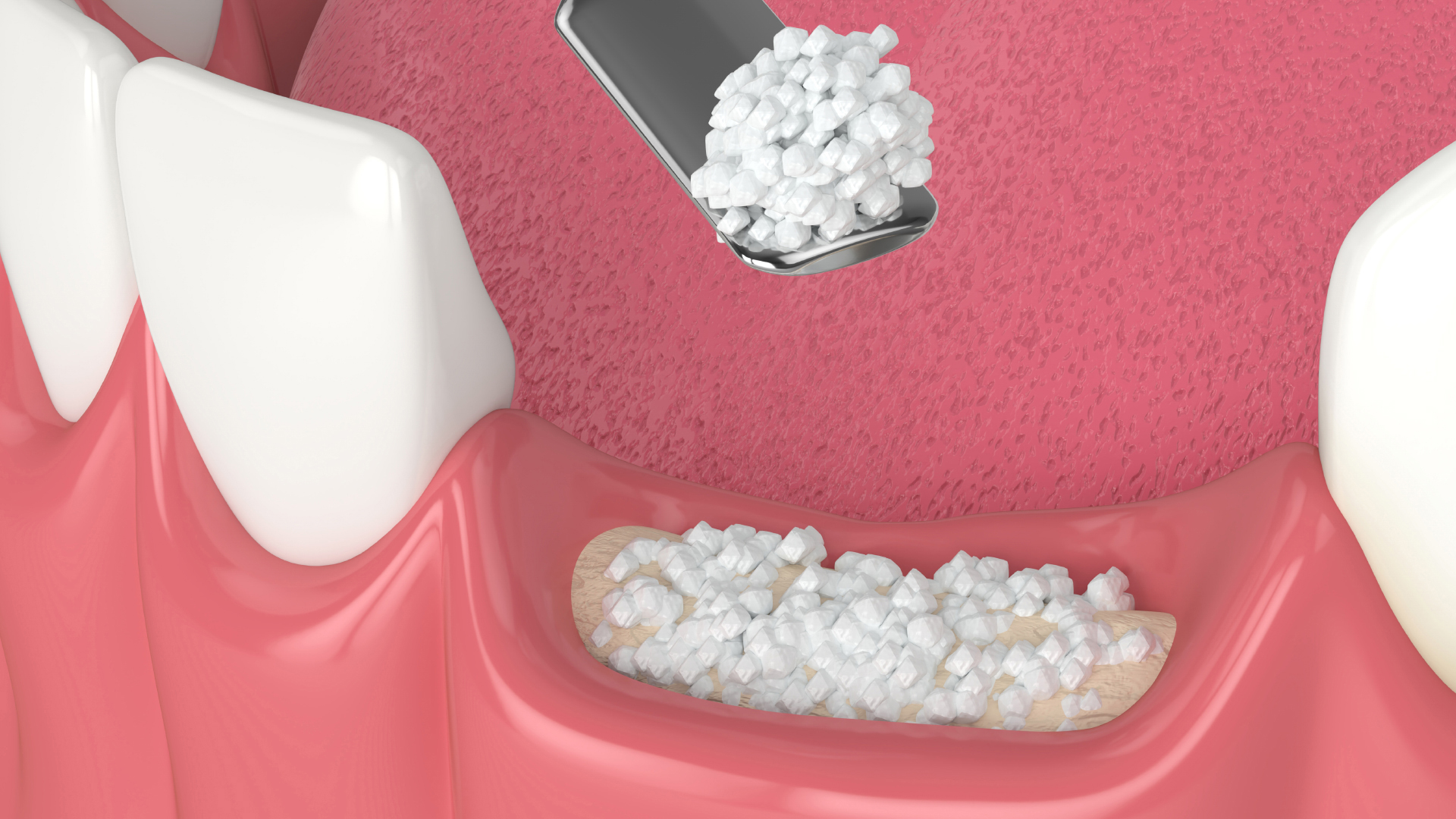 Schéma 3D d'une greffe osseuse dentaire