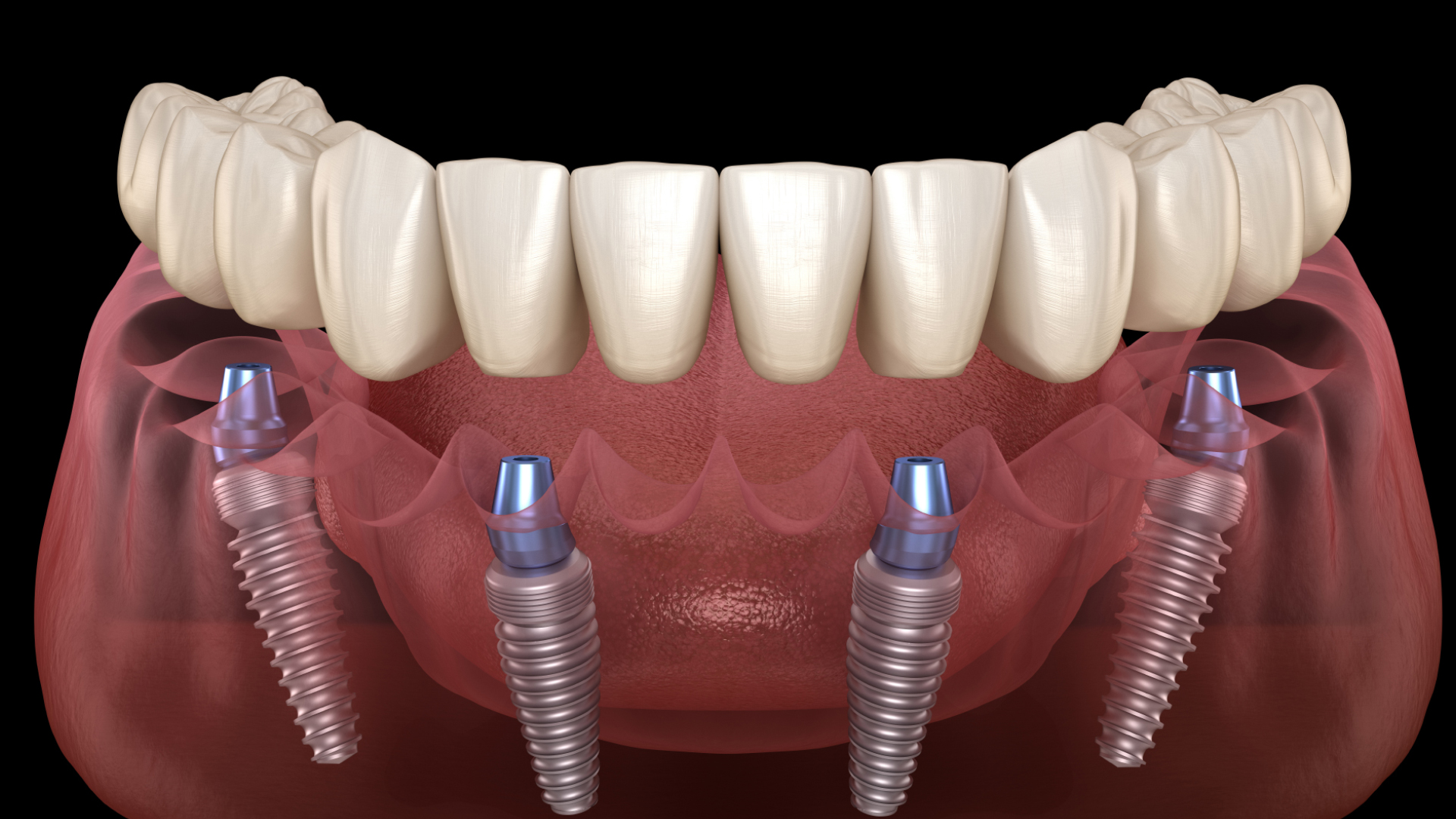 All-On 4: Everything you need to know about All-On 4 dental system