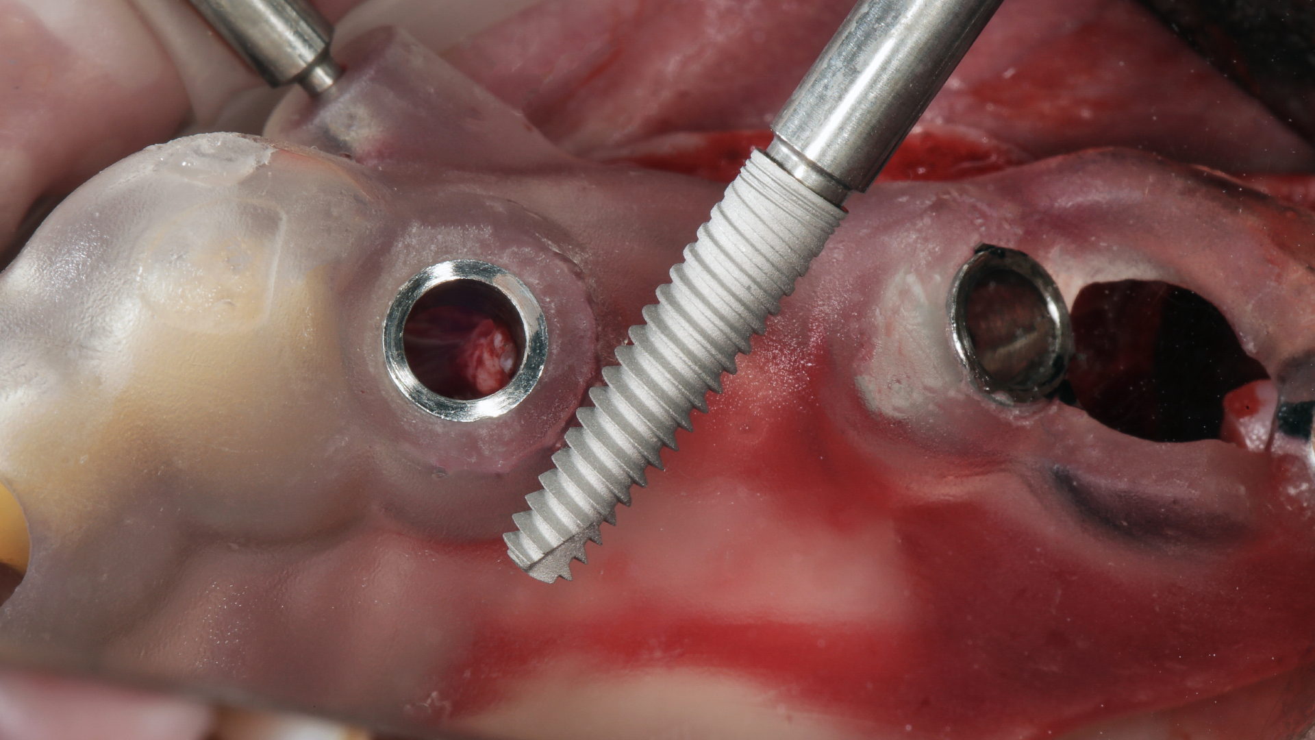 A dentist in Antalya placing a dental implant pilar