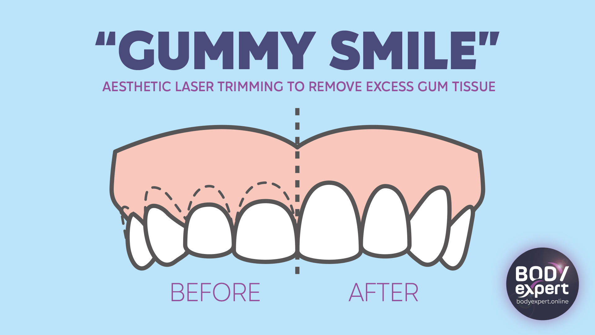 Gummy smile correction