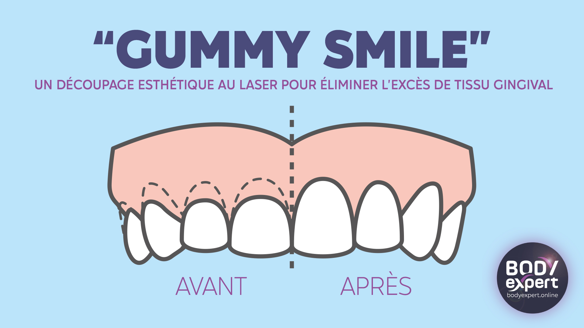 Gummy Smile : avant et après