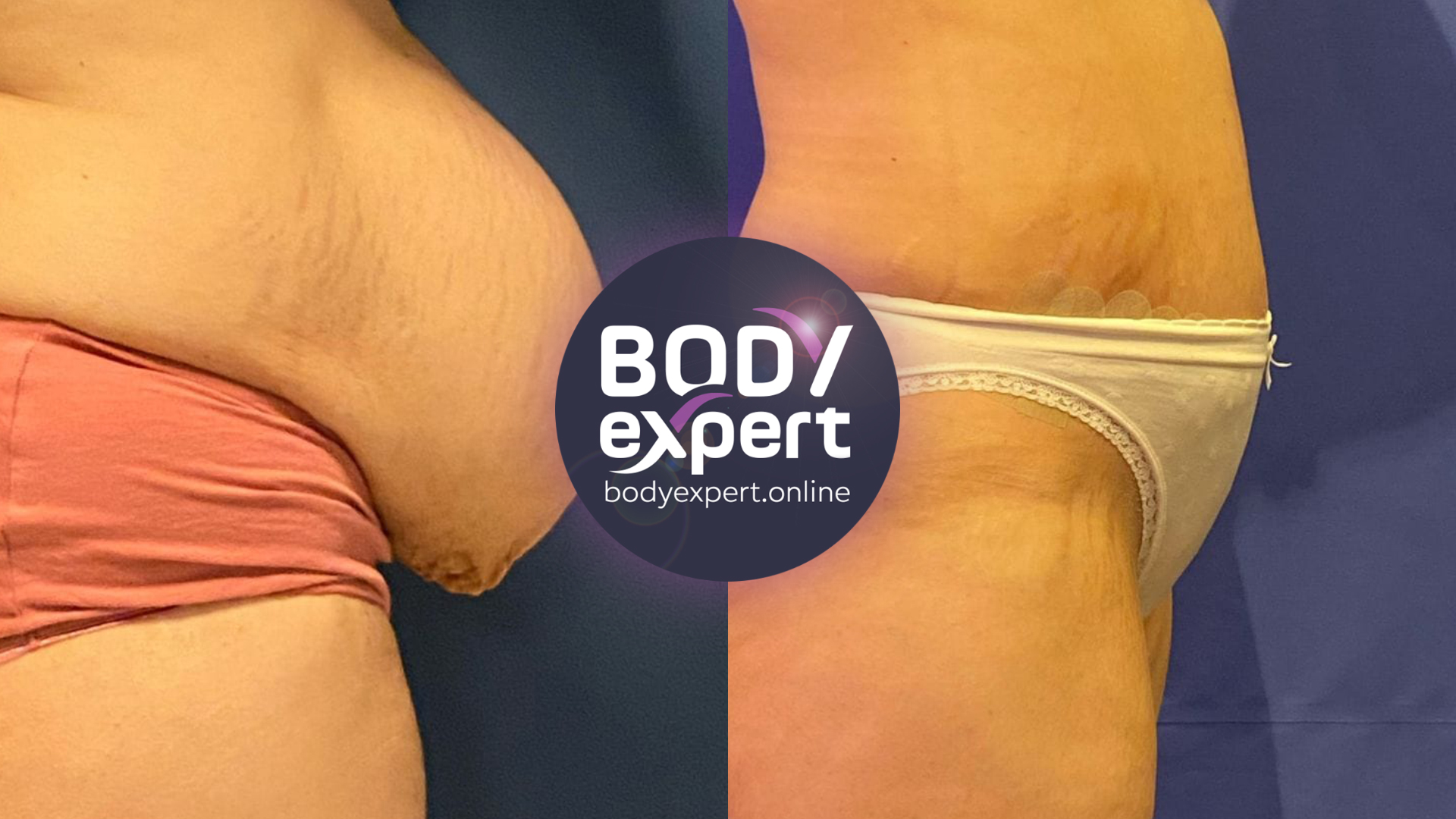 Tummy Tuck after weight loss, before and after