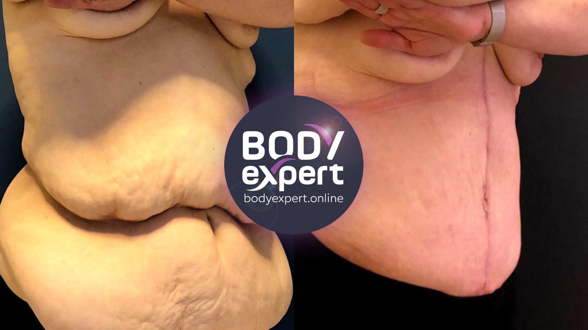 Breast Augmentation After Weight Loss