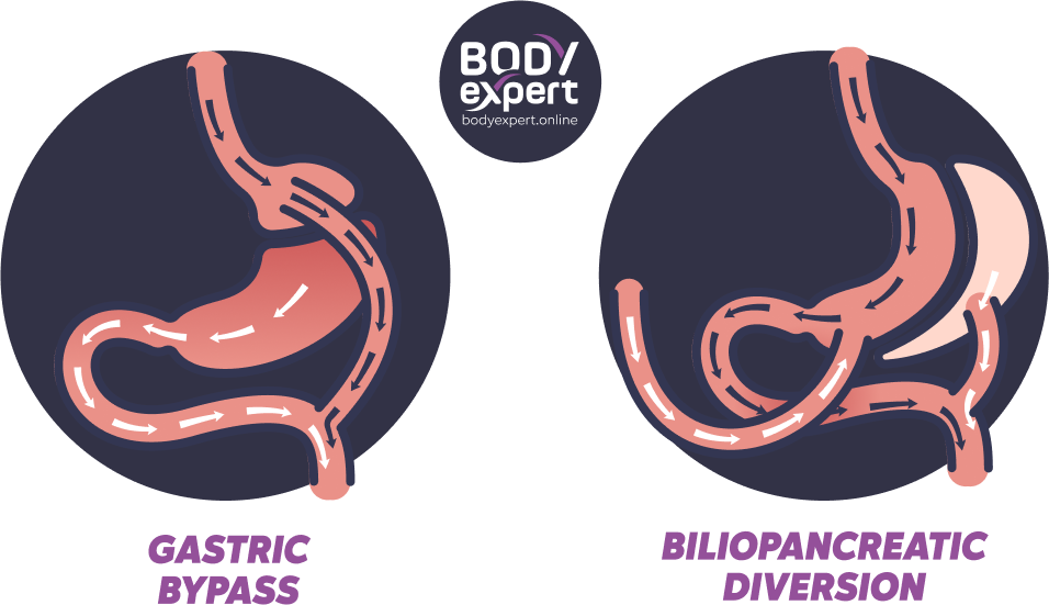 Dessin page Chirurgie Bariatrique_EN-techniques-hybrides