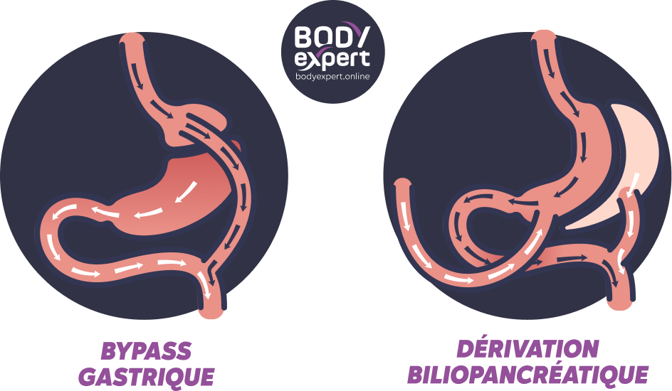 Chirurgie bariatrique en Turquie prix et avis Body Expert