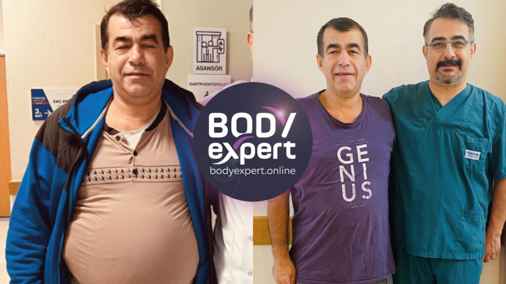 Before and after photos of a gastric band placement, testifying to its effectiveness in controlling obesity.