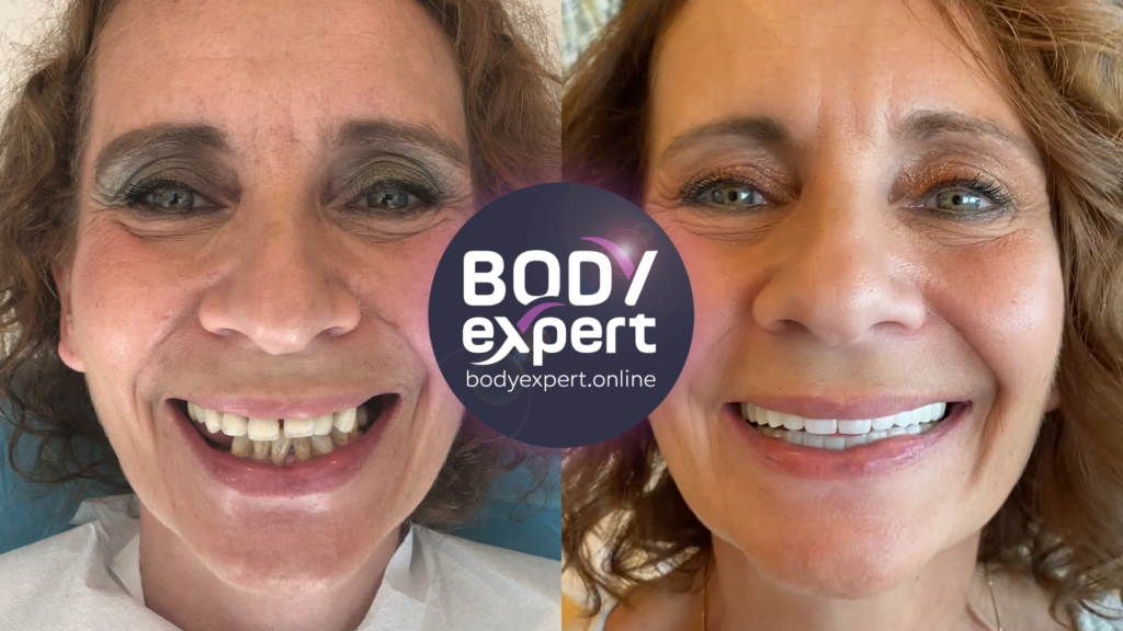 Before-after comparison of a dentition rehabilitation using the All-on-6 technique for an optimal aesthetic and functional result.