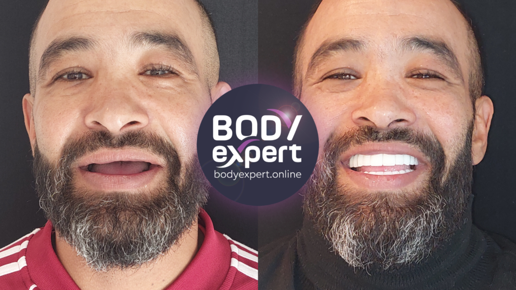 Photos avant et après un traitement All-on-6, mettant en évidence la transformation radicale de la dentition et du sourire.