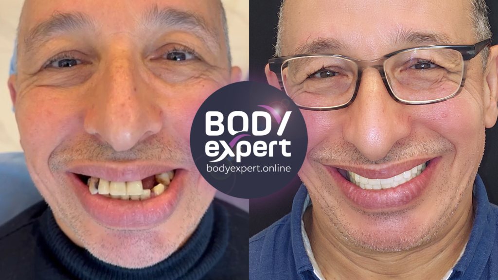 Résultat spectaculaire d'une réhabilitation par la méthode All-on-6, photos avant et après témoignant du changement radical de la dentition.