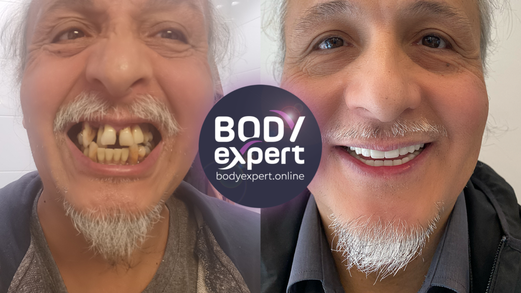 Before-after of an All-on-4 treatment for a complete rehabilitation of the dentition in record time.