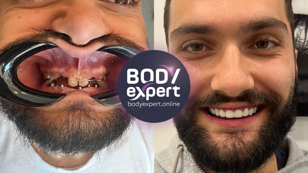 Photos avant et après une réhabilitation All-on-6, révélant une dentition esthétique, fonctionnelle et naturelle malgré la perte de nombreuses dents.
