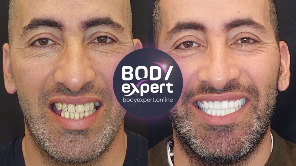 Striking before-after comparison of an All-on-4 treatment for a radical change in dentition and smile.
